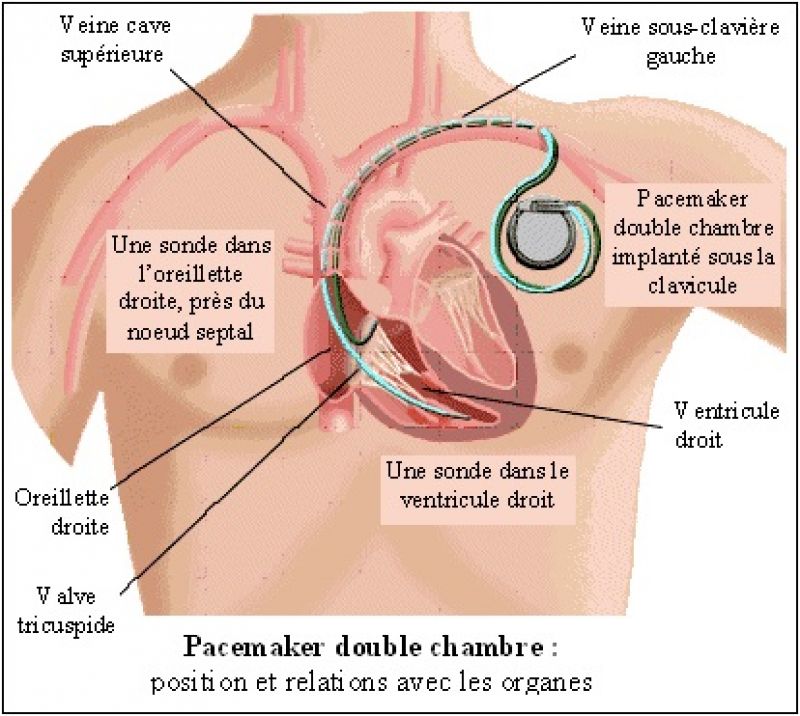 Amélioration du Pacemaker grâce à la la technologie de pointe